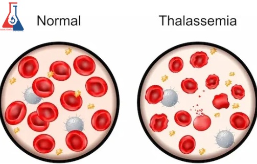 کم-خونی-تالاسمی