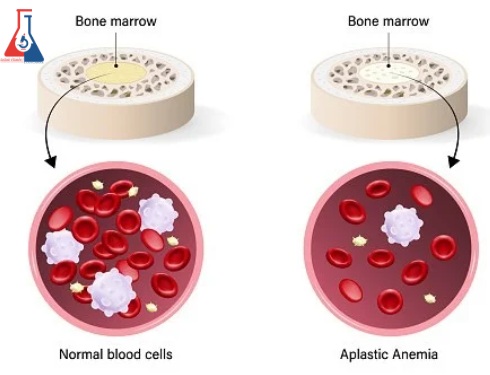 کم-خونی-آپلاستیک