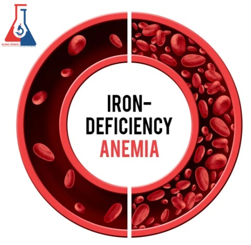 کم-خونی-فقر-آهن