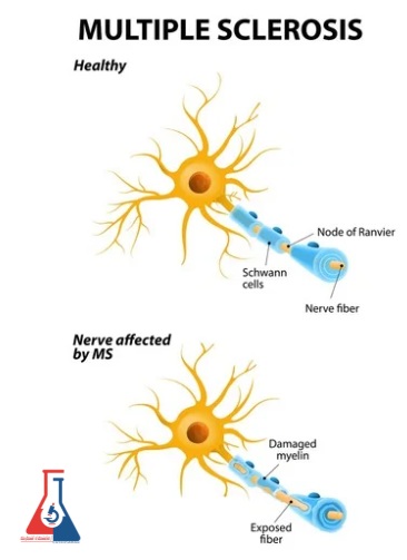 بیماری ام اس