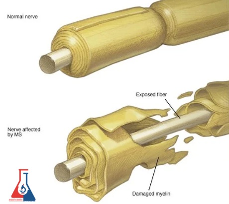 بیماری ام اس