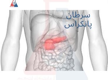 سرطان پانکراس (لوزالمعده)