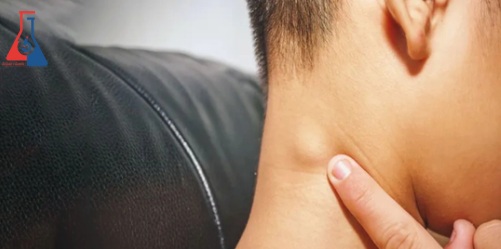 لنفوم هوچیکن