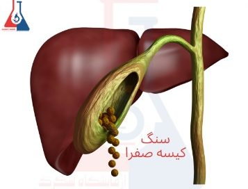 سنگ کیسه صفرا